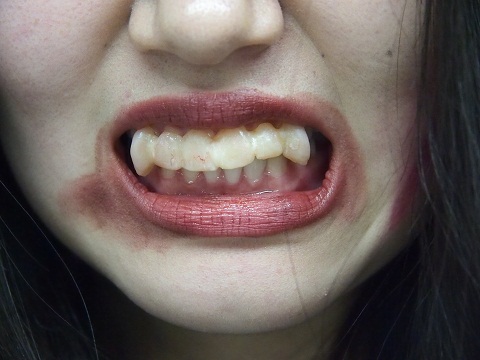 歯科付け牙